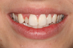 25 year old female, chief complaint &mdash; 'Really crooked teeth that make me embarrassed.' <strong>Diagnosis: </strong>Crowding. <strong>Treatment:</strong> Invisalign removable plastic aligners in one year.