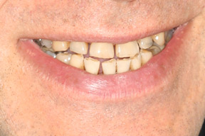 50 year old male, chief complaint &mdash; 'Spaces developed between my teeth.' <strong>Diagnosis:</strong> Collapsed bite due to heavy clenching habit. <strong>Treatment:</strong> Full mouth reconstruction in four primary visits.