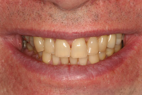 60 year old male, chief complaint &mdash; 'Constant headache pain from clenching, bridges cracked, teeth are yellow.' <strong>Diagnosis:</strong> Worn bite with old broken down crowns. <strong>Treatment:</strong> Full mouth reconstruction with all porcelain teeth.