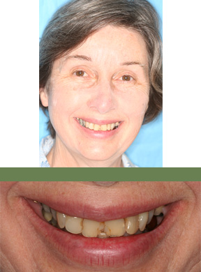 <strong>What concerned the patient?</strong> Pain with chewing. Front teeth are broken. <strong>Condition:</strong> Large silver fillings in back teeth had cracks and cavities and many front teeth had broken bonding.  Several teeth hurt when chewing. <strong>What was done:</strong> Replaced old dentistry in all upper teeth and lower back teeth with new enamel-like, all-ceramic crowns; restored all worn-down teeth to their natural shape and size; Gloria was happy with the appearance of her lower teeth so we matched all cosmetic work to Gloria�s natural lower front teeth. Completed in four primary office visits. <strong>Patient's Comments After Treatment:</strong> Gloria reports that her tooth pain when chewing is gone. She also said her aesthetics and bite comfort have improved.