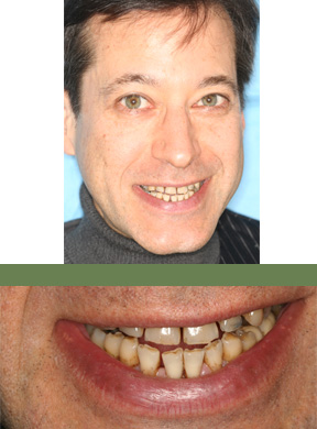 
            <strong>What concerned the patient?</strong> Losing my teeth. <strong>Condition:</strong> Many crowns in the back of the mouth were cracked, front teeth were spread apart, several teeth were loose. <strong>What was done:</strong> Replaced all old dentistry with new enamel-like, all-ceramic crowns; restored all worn-down teeth to their natural shape and size; balanced the bite on all teeth to prevent further spreading and loosening.  Completed in four primary office visits. <strong>Patient's Comments After Treatment:</strong> When Norman gave us permission to use his photos he added that this marked his beginning as model.